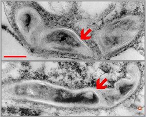 phagocytosed Nocardia (Actinomycetales)in brain abscess phagocytosed Nocardia (Actinomycetales)in brain abscess